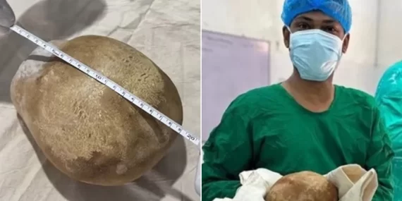 Mesanesinden 3,1 kiloluk taş çıktı: Doktorlar hayret etti