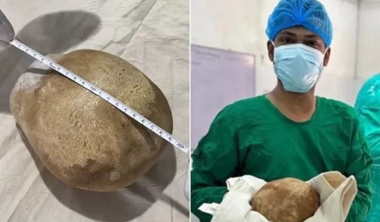 Mesanesinden 3,1 kiloluk taş çıktı: Doktorlar hayret etti