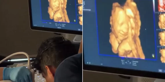 Ultrasonda şaşırtan gülümseme: Bebek babasının sesine mi tepki verdi?