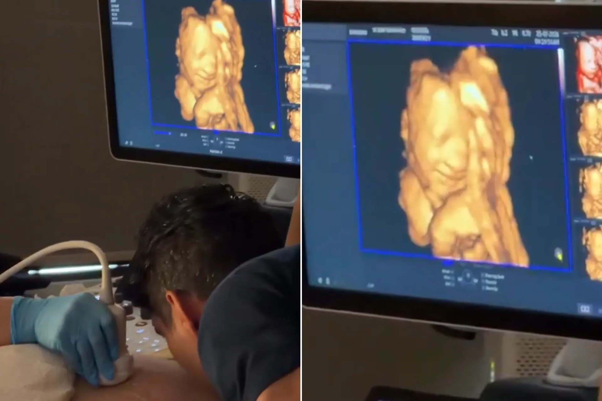 Ultrasonda şaşırtan gülümseme: Bebek babasının sesine mi tepki verdi?