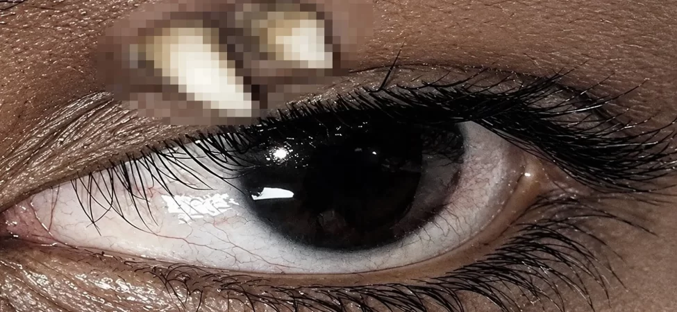Göz kapağında beliren beyazlık doktorları şoke etti: Diş çıktı!